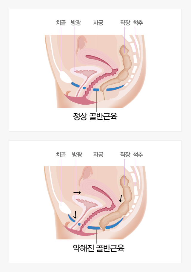 골반저근육복원술,질탈출증,자궁적출술